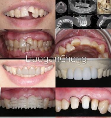 China Biokompatibilität Sichere Zirkonia-Zahnkranzen für langfristige und implantatgestützte Restaurierungen zu verkaufen