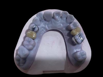 China Coronas de porcelana de metal libre de aleación dental de corona PFM de alta precisión en venta