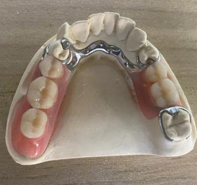 China Dentura de marco de metal de plata confiable resistencia a la corrosión con diseño personalizable en venta