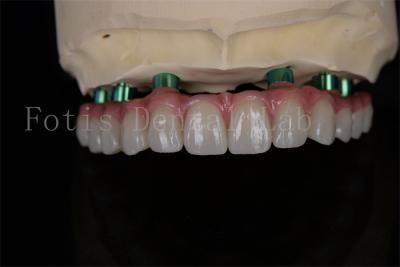 중국 Zirconia All-on-4 임플란트 수술 같은 날 회복 최소한의 후속 치료가 필요합니다 판매용