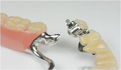 Chine Denture partielle amovible de précision Professionnel stable à vendre
