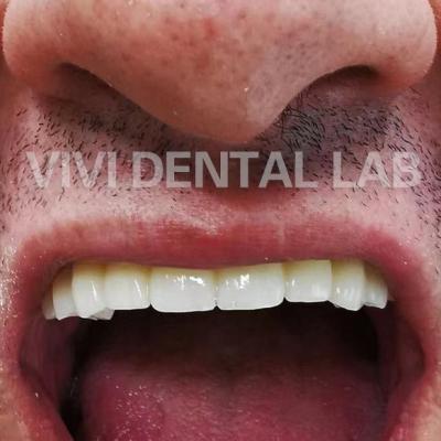 Chine Dentiste numérique plein pont en zirconium dans la bouche professionnel stable à vendre