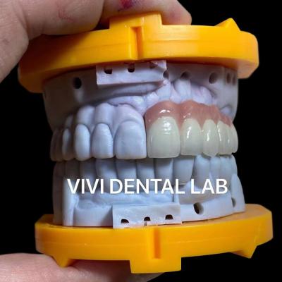 Chine Ivoclar PFM Couronnes dentaires numériques pont symétrique avec la porcelaine rose à vendre