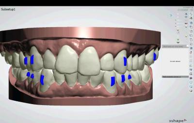 Chine Correction professionnelle de l'alignement des dents à vendre