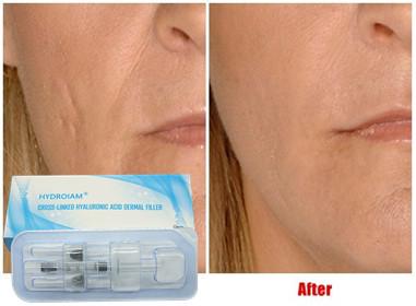 China Llenador inyectable ácido hialurónico 10ml para las mejillas Chin Augmentation de la inyección del labio en venta