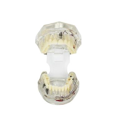 China Transparent Pathological Tooth Model Dental With Tooth Nerve Customization for sale