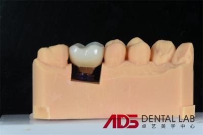 China Dental Dentes faltantes Cemento Implante retenido Reemplazo de la corona de la costumbre en venta