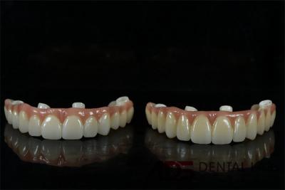 Chine Titane biocompatible tout sur 6 implants dentaires pont pour la dent à vendre