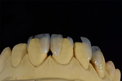 China Aesthetic Durable and Stain-Resistant Dental Veneers from direct China Shenzhen dental lab en venta
