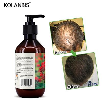 China 300ml Loss Prevention Shampoo For Hair Loss Treatment Hair Growth Products With No Side Effects for sale