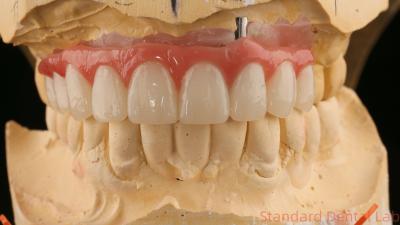 China Good Fitting Precise Esthetic Zirconia Porcelain Crown Pink Porcelian With Bleaching Shade for sale