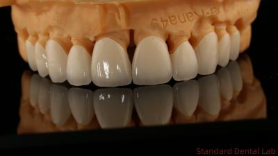 China Full Contour Dental Lab Crowns High Translucency Solid Zirconia Crown China Dental Lab for sale