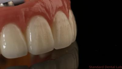 Chine Laboratoire dentaire professionnel de la couronne d'implant dentaire en zircone en titane CAD CAM à vendre
