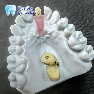 Chine Abutment en zirconium fraisé de précision avec couronne d'implant unique à vendre