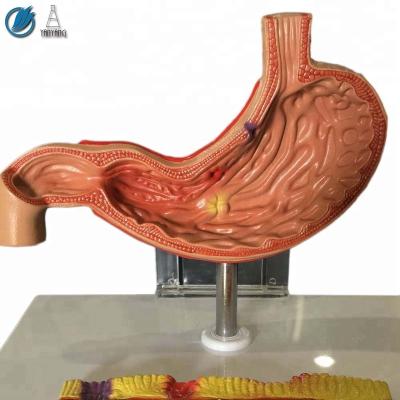 China Medical Human Plastic Ulcer Stomach Model With Description Plate for sale