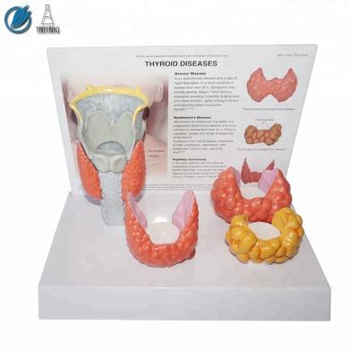 China medical medical thyroid pathological model for sale