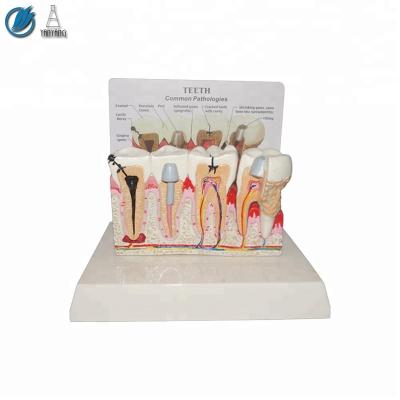 China Medical human pathologies anatomical teeth model for demonstration for sale