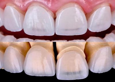 China Long Lasting Dental EMAX Veneer Fabricated With All Ceramic Zirconium Material for sale