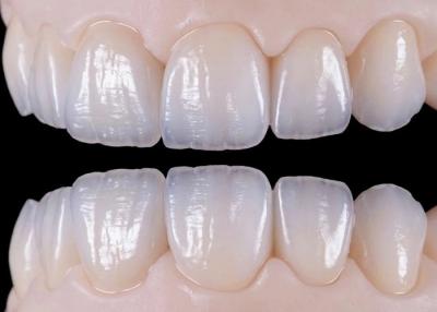 China Ponte de coroa dentária de cerâmica natural resistente ao desgaste para restauração natural à venda