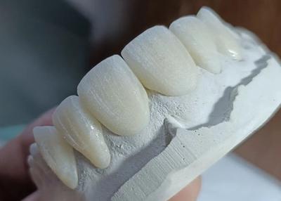 China Ponte de coroa de cerâmica resistente ao desgaste para restauração dental confortável e precisa à venda