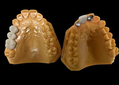 Cina Porcellana di trasparenza moderata fusa al metallo corona PFM, corona ceramica PFM in vendita