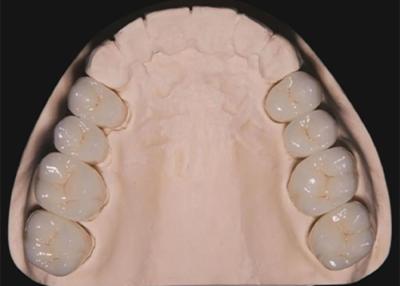 China Restauración dental de dientes Coronas de zirconio, coronas de dientes duraderas hechas de zirconio en venta