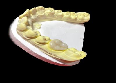 China Enlaces de cerámica lisa Enlaces de restauración dental fuerte e hipoalergénico para dientes dañados en venta