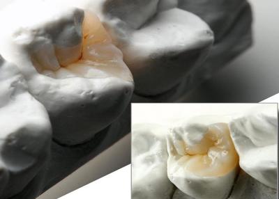 China Laboratorio dental de aspecto natural Incremento y onlay de cerámica para restauración dental precisa en venta