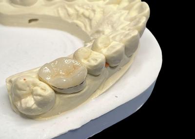 China Reparación de dientes hipoalergénicos Inlays de porcelana Onlays de color natural Mantenimiento fácil en venta