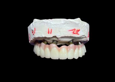 Cina Impianti dentali con protesi a arco completo fisse per una soluzione permanente, stabile e naturale ai denti mancanti in vendita