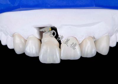 China Coroa de implantes dentários com abutment de titânio para sorrisos de aparência natural à venda