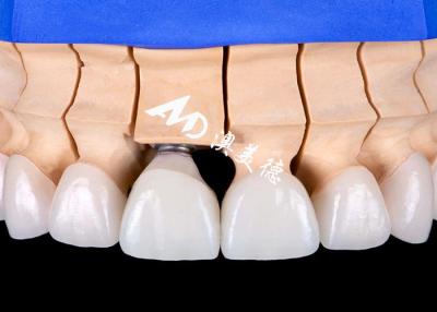 China Implante Dental Estético Funcional Ponte da Coroa Precisão e Durabilidade à venda