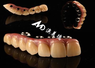 China Implante Dental de Aparência Natural Ponte da Coroa Fixada com um pilar de Titânio para Cirurgia de Dentes Faltantes à venda