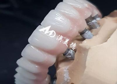 China Exclusivo Implante Dental de Alto Desempenho Crown Bridge Vários Tamanhos Disponíveis à venda