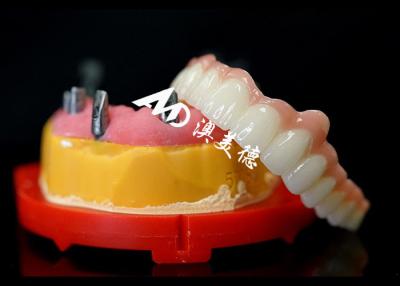 China Customized Shape Dental Implant Crown Bridge For Missing Teeth Maintenance for sale