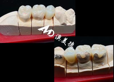 China Inlays y onlays de cerámica de ajuste de precisión OEM para una restauración dental natural fuerte en venta