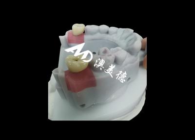 China Dental Implant Crown And Bridge with titanium abutment for Durable Tooth Restoration for sale