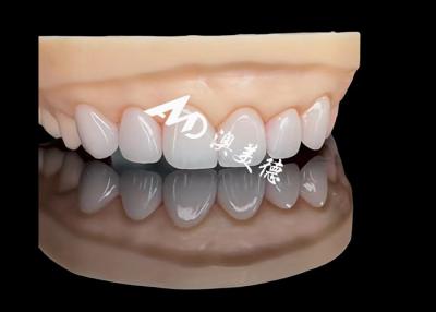 China Chemical Bonding Porcelain EMAX Veneer Esthetic Restorations Highly Accurate for sale