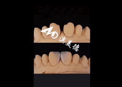 China 0.3-0.5mm Ultra dünne IPS EMAX Porzellan Veneers für ästhetische Lächeln Makeovers zu verkaufen