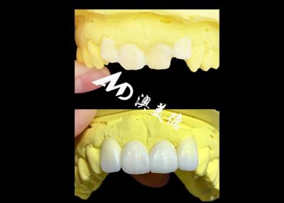 China Custom Translucent Zirconia dental Crowns Crafted by AMD Dental Lab for sale