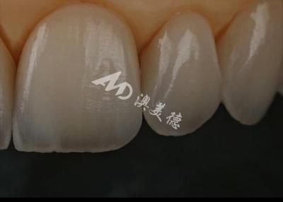 China Resistencia a las astillas Corona dental de zirconia para dientes anteriores / posteriores en venta