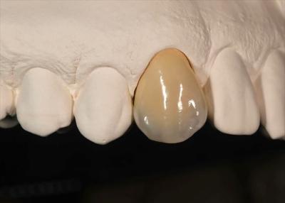 China Resistência à mancha Coroa de zircônio sólido para dentes da frente dentes posteriores à venda