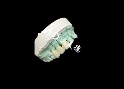 China Coroa de cerâmica Emax Solução personalizável e acessível para restauração dentária à venda