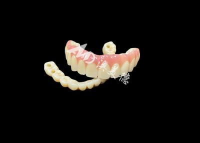 China Las prótesis dentarias con implantes Puente La solución dental definitiva para los dientes perdidos en venta