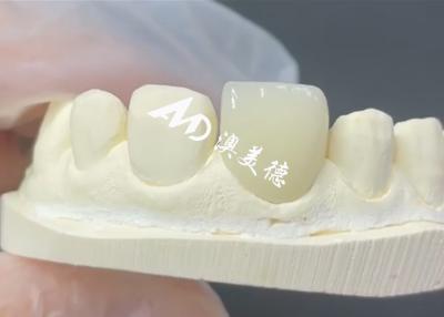 China La carilla EMAX es la solución ideal para restauraciones dentales duraderas y estéticas en venta