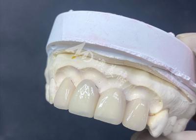 China Obtenga una sonrisa impecable con carillas dentales hechas con precisión: conchas de porcelana hechas a medida en venta