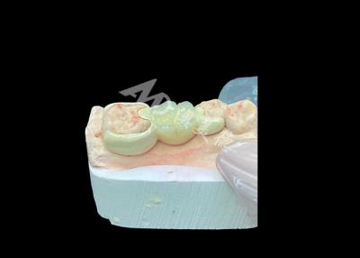 China Zirconia Crown with HPP Bonded Bridge for Enhanced Smile Aesthetics and Biocompatibility for sale