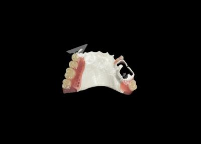 Κίνα High Quality Comfortable Partial Denture With HPP Framework Restores Chewing And Speaking Ability προς πώληση