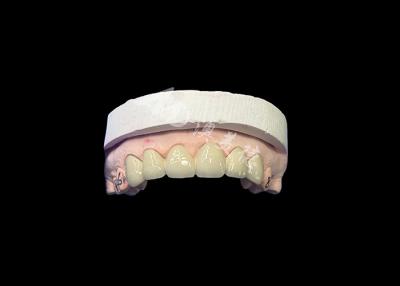 China Biocompatible Porcelain Fused to Metal Crown for Enhanced Restoration en venta