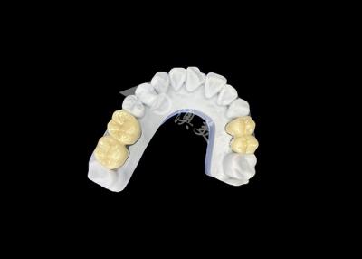 China Zirconia PFZ porseleinen tandkronijn van professioneel China tandheelkundig lab Te koop